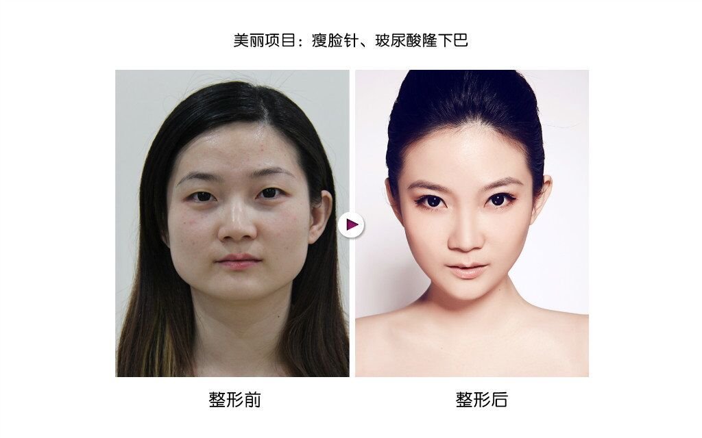 打瘦脸针多久有效果