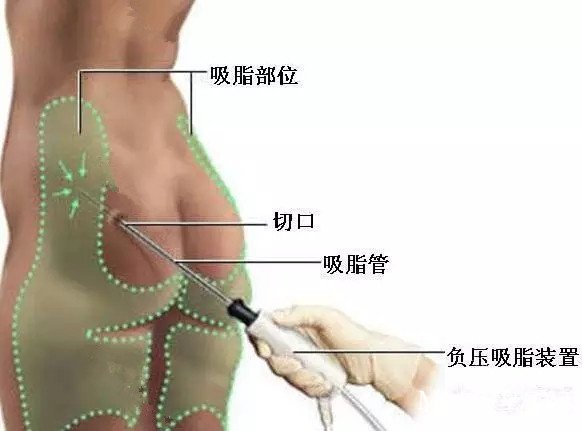 吸脂的术后效果能维持多久