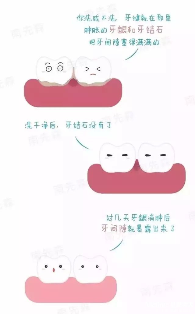 洗牙会让牙缝变大吗?