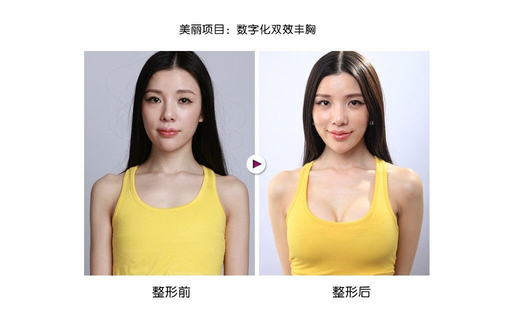 自体脂肪隆胸适合哪些人