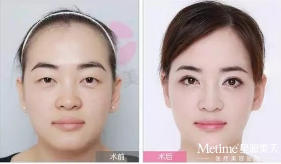 做双眼皮多长时间恢复