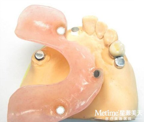 磁性附着体模型图