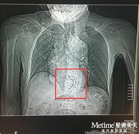 王老先生的CT片显示 体内有假牙托异物
