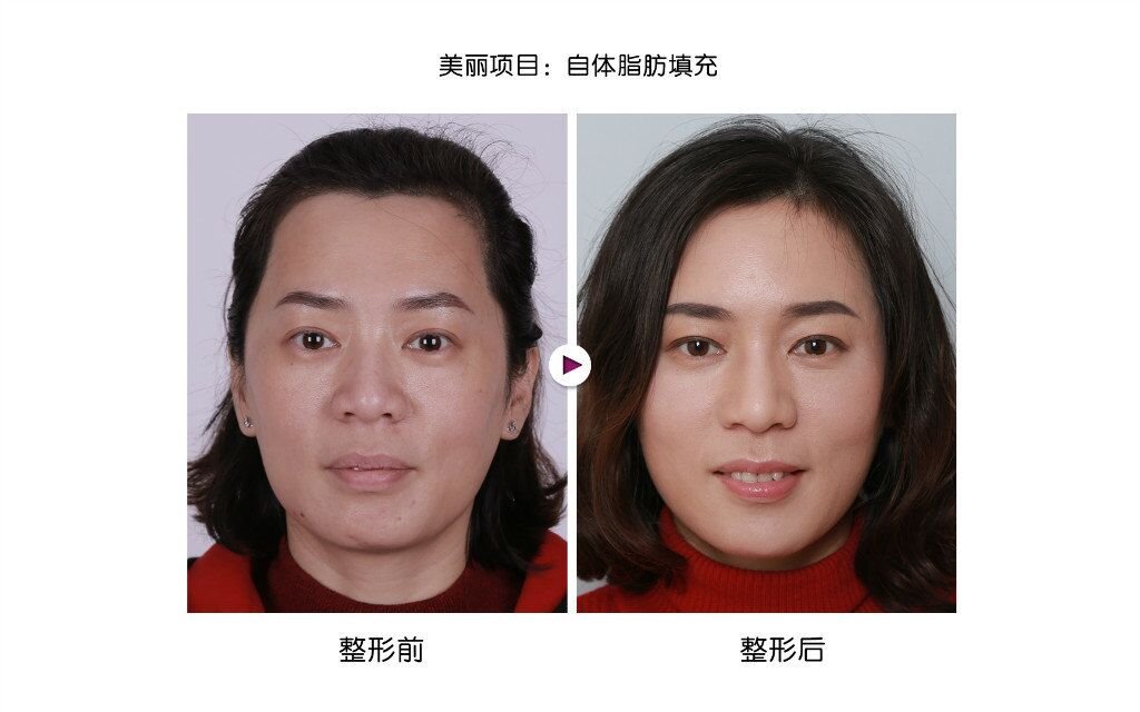 自体脂肪填充副作用