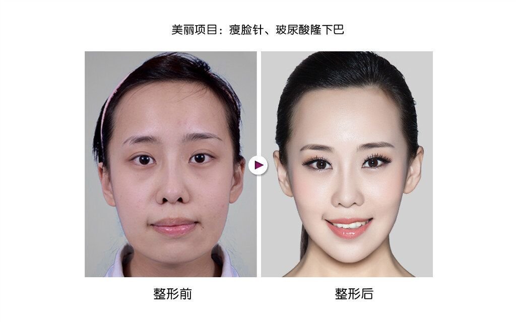 玻尿酸打造心形脸