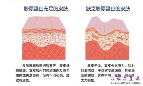注射胶原蛋白原理 如图示