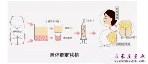 自体脂肪填充原理 如图示
