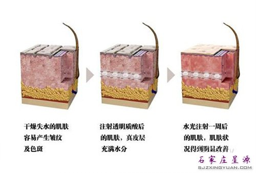 注射玻尿酸
