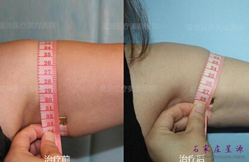 紫晶蛋白美人线去除蝴蝶袖治疗对比
