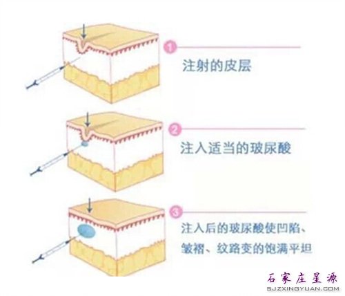 注射玻尿酸 恢复肌肤年轻态