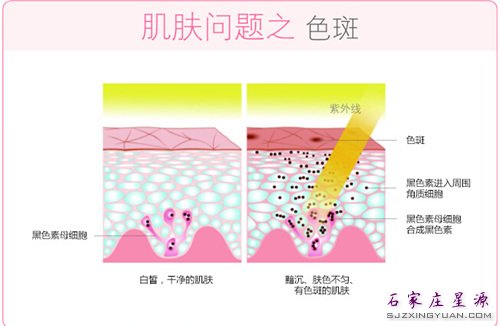 一张图告诉你:色斑是怎样形成的……