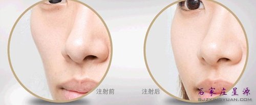 面部填充对比图 一