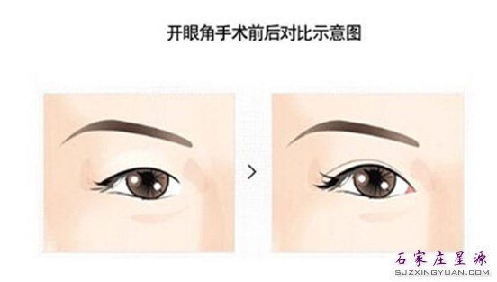 开眼角效果不错
